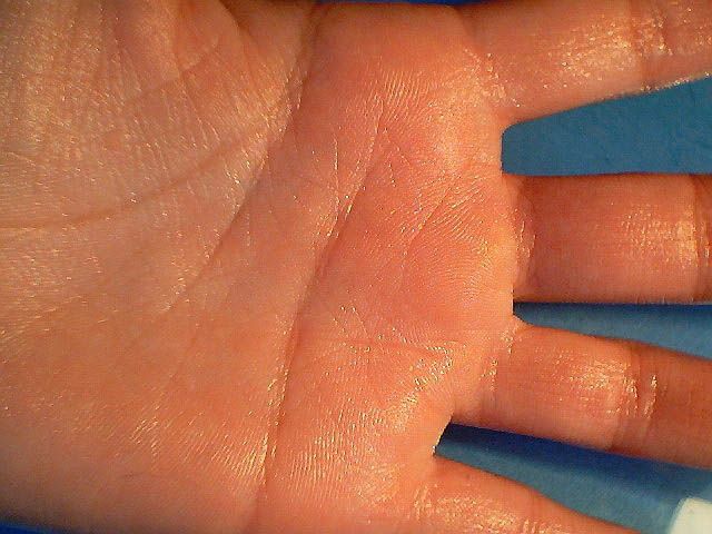 Потливость ладоней – причины, симптомы, диагностика и лечение гипергидроза ладоней
