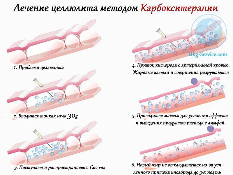 Уколы карбокситерапии или безинъекционная карбокситерапия? - акриол про