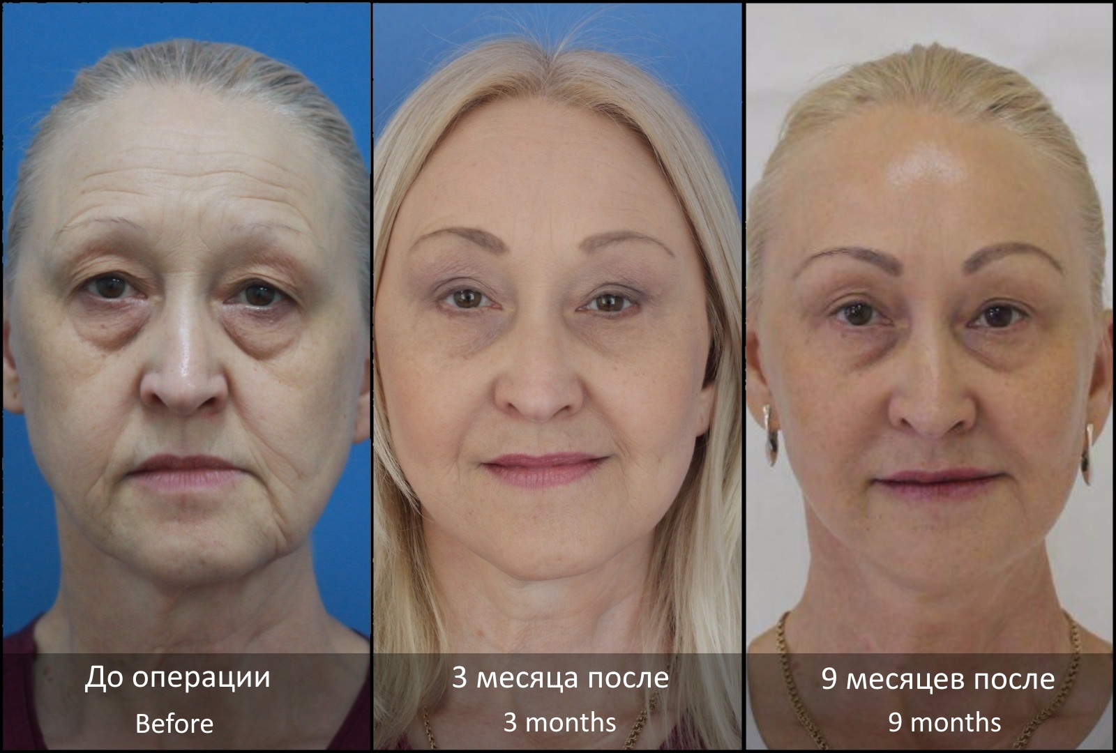 Подтяжка лица хирургическим путем. Цена, как выбрать врача, виды операции