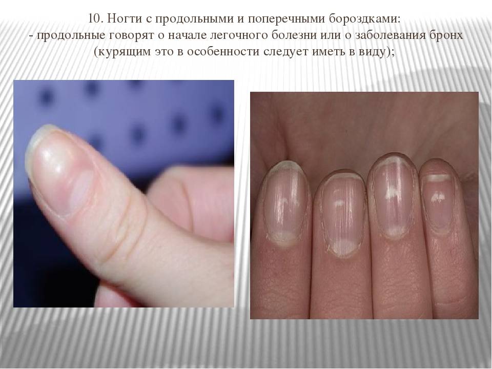 Почему на ногтях появились бугорки и впадины