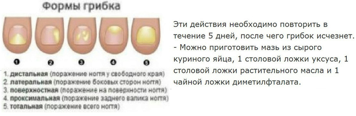 Йод против грибка ногтей - свойства препарат для лечения, рецепты народной медицины и ванночек