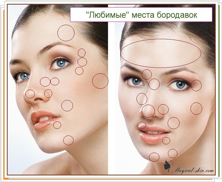 Как избавиться от бородавок на лице дома