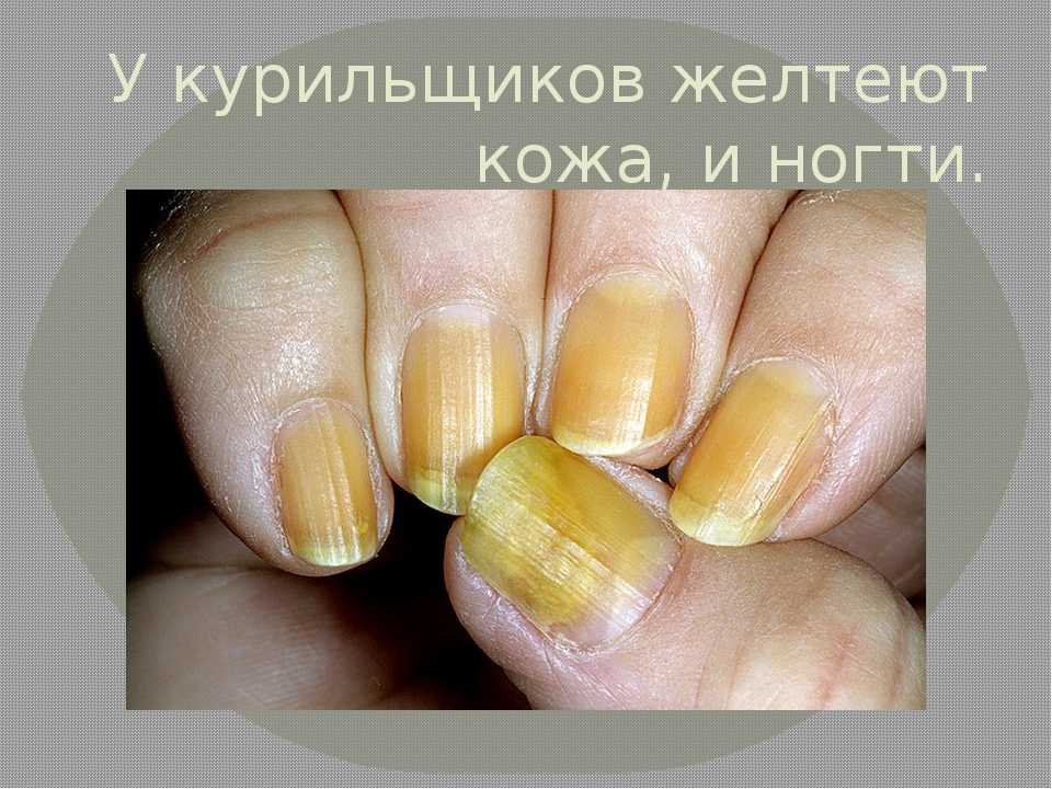 Причины пожелтения ногтей на руках