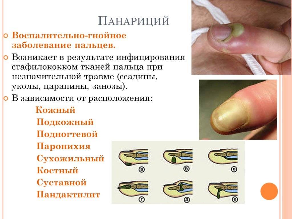 Лечение околоногтевого панариция