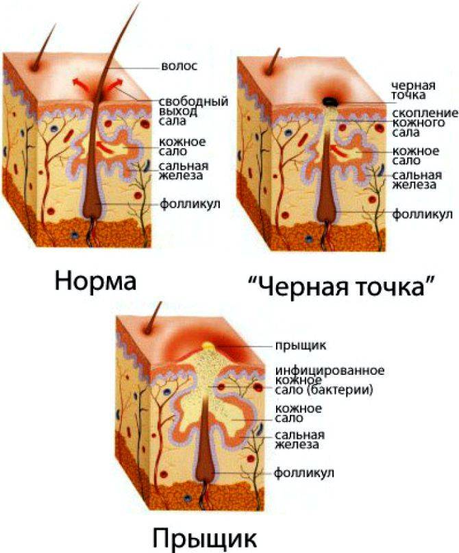 Как избавиться от комедонов на лице в домашних условиях