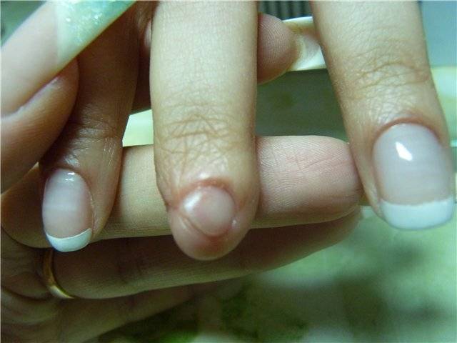Травма ногтя руки — повреждение ногтевой пластины