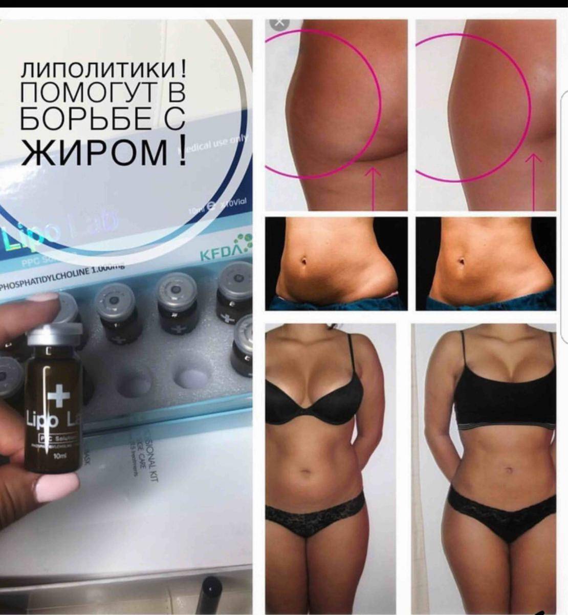 Мезотерапия тела для похудения