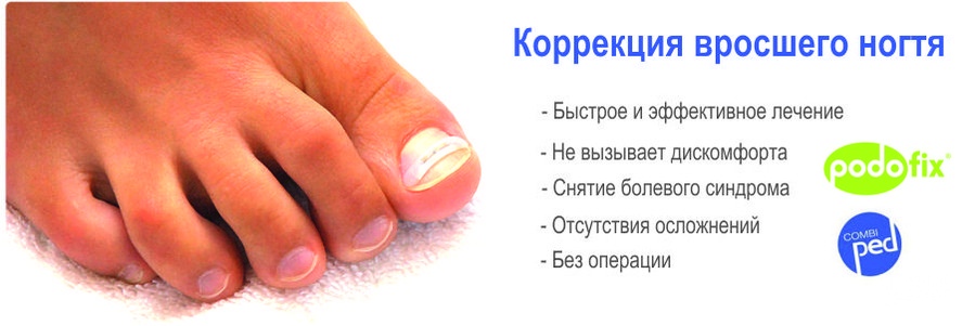 Как избавиться от вросших ногтей