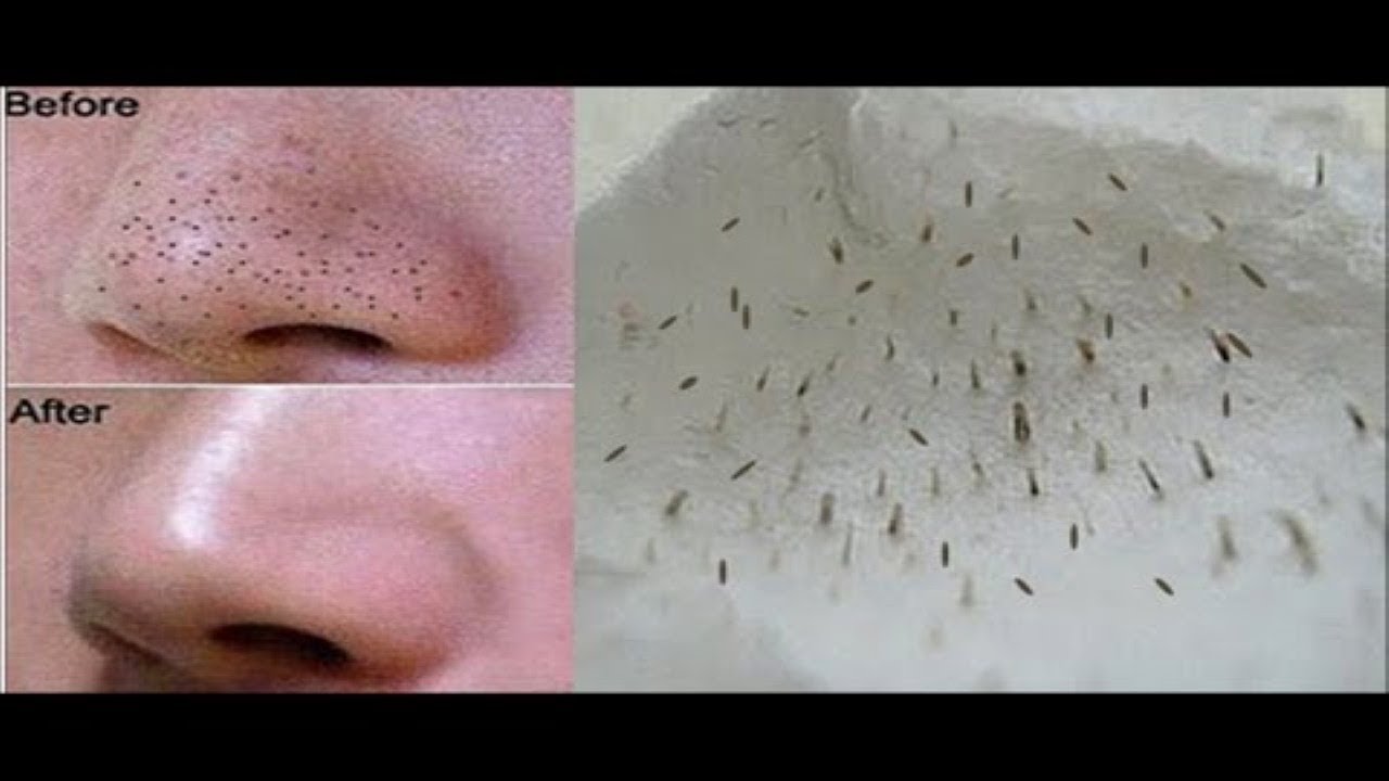 Почему появляются закрытые комедоны и как их лечить?