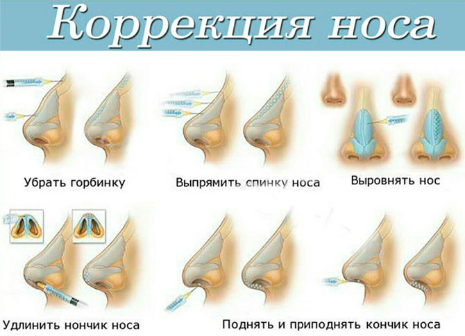 Коррекция носа методами эстетической медицины. что можно изменить, не прибегая к операции? — центр эстетической медицины
