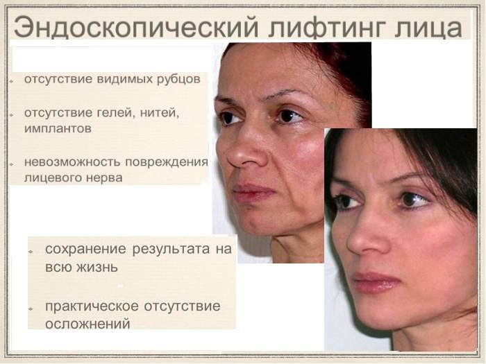 Эндоскопическая подтяжка лица отзывы - пластическая хирургия - первый независимый сайт отзывов россии
