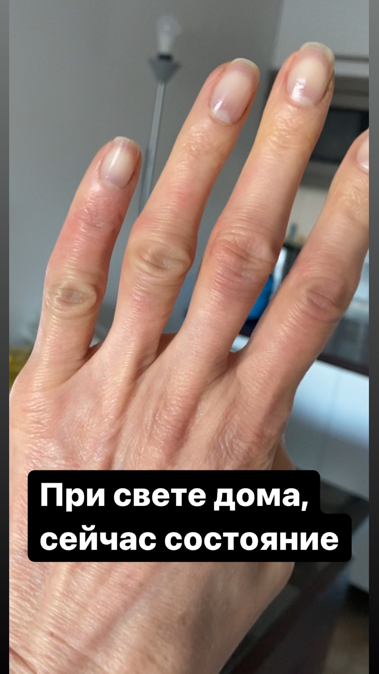Воспаление пальца после удаления заусеницы