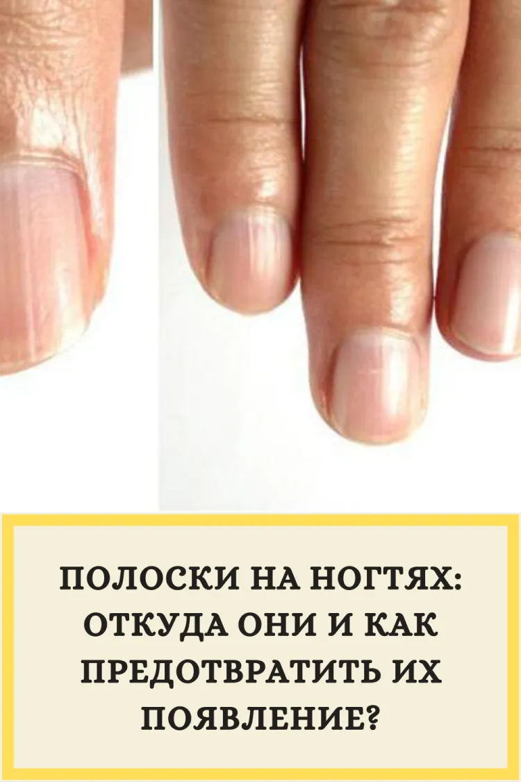 Причины появления продольных полос на ногтях рук - как лечить