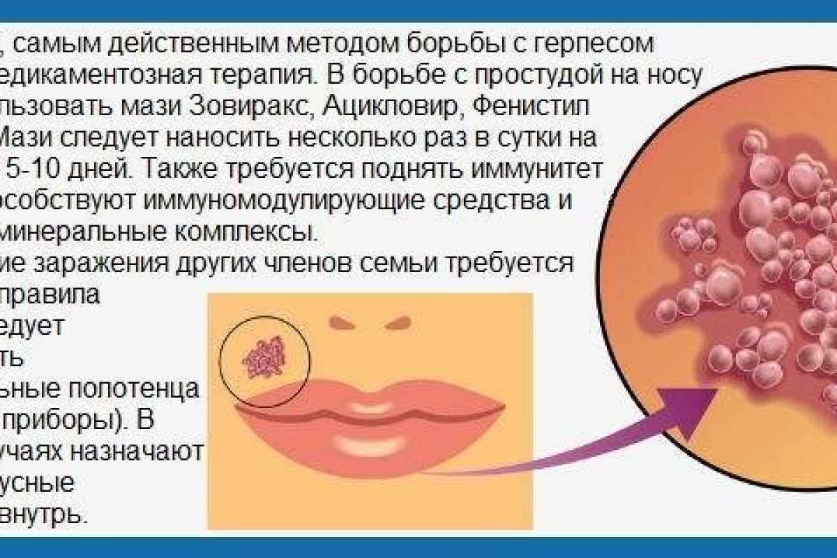 Герпес (простуда) на губах: причины, симптомы, лечение, профилактика