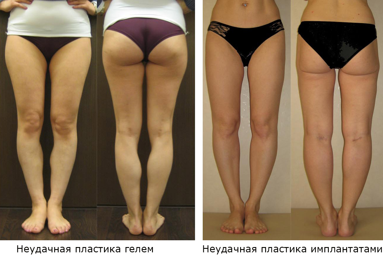 Кривые ноги — страшный диагноз, но если вы не слышали это от врачей с самого детства, ситуацию очень легко исправить +видео