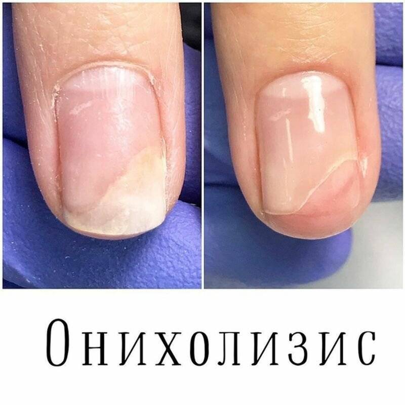 Как проявляется псориаз ногтей и чем отличается от грибка? лечение заболевания.