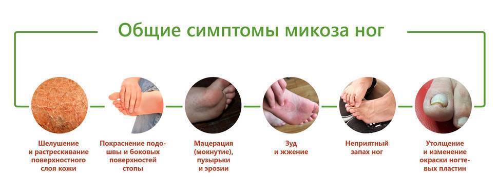 Грибок ногтей