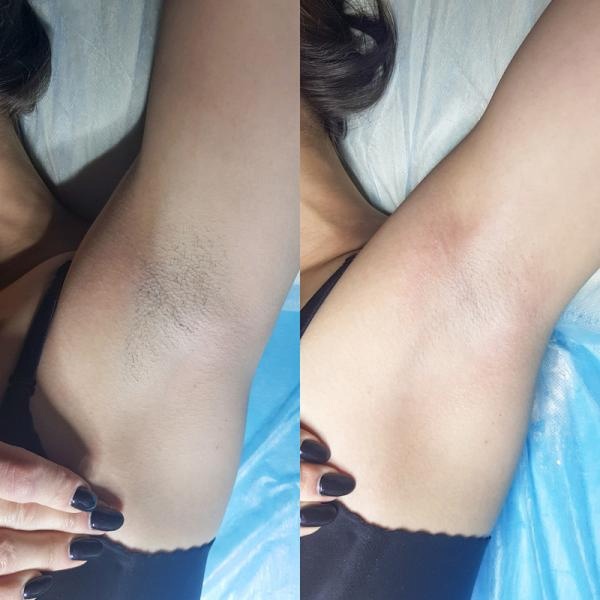 Эпиляция подмышек: биоэпиляция, шауринг, лазером и фотоэпиляция.