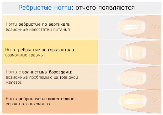Почему ногти становятся бугристыми, волнистыми и ребристыми? причины деформации, лечение и профилактика проблемы