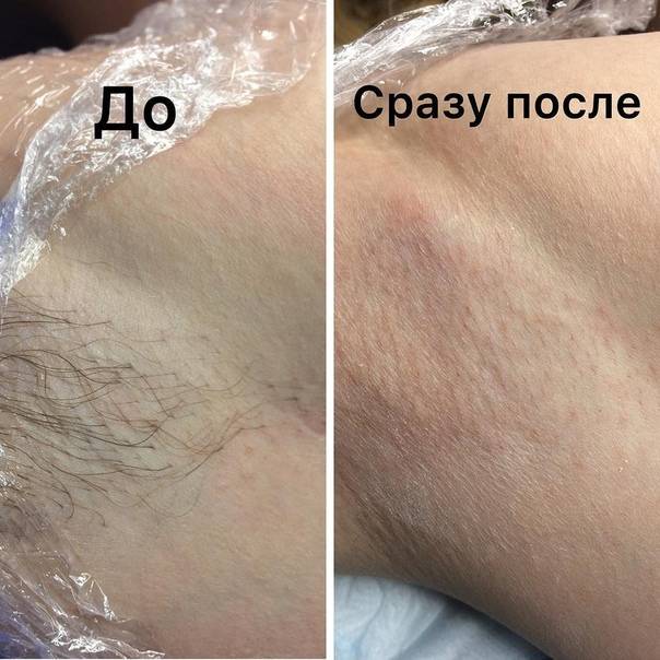 Шугаринг глубокое бикини: подготовка, как делают, уход, отзывы (фото, видео)