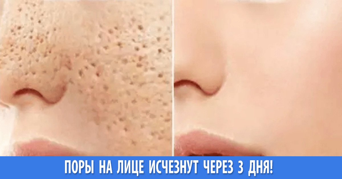 Расширенные поры на лице как избавиться без вреда коже