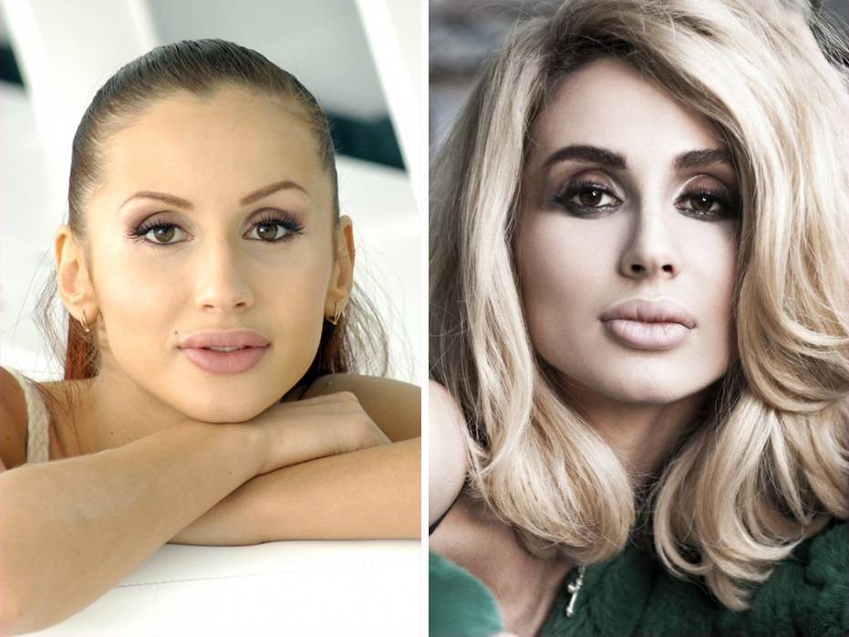 Пластические операции светланы лободы (фото)