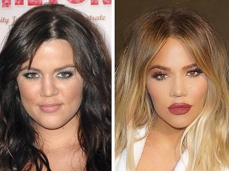 Хлоя кардашьян делала пластическую операцию? предполагаемые фотографии до и после - отношения - 2024