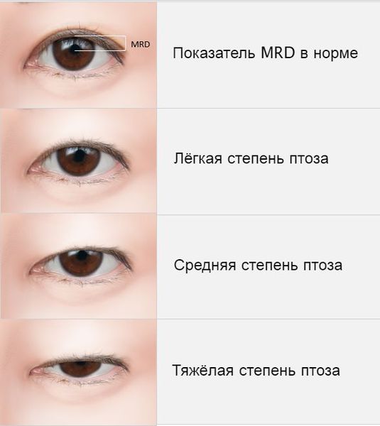 Коррекция птоза верхнего века | александр маркушин пластический хирург