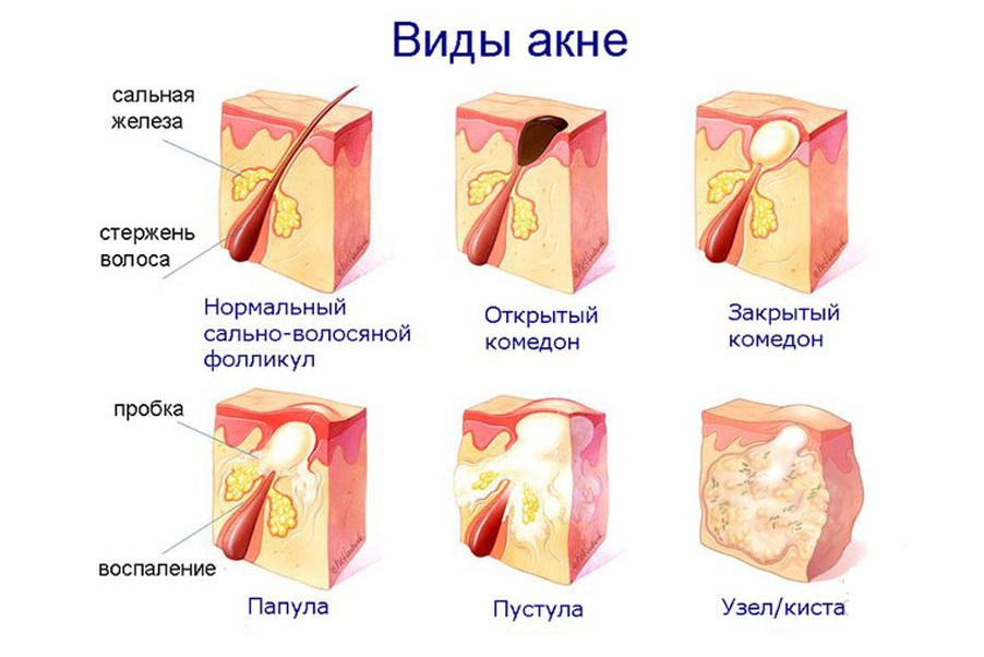 Как избавиться от внутренних подкожных прыщей - минолексин