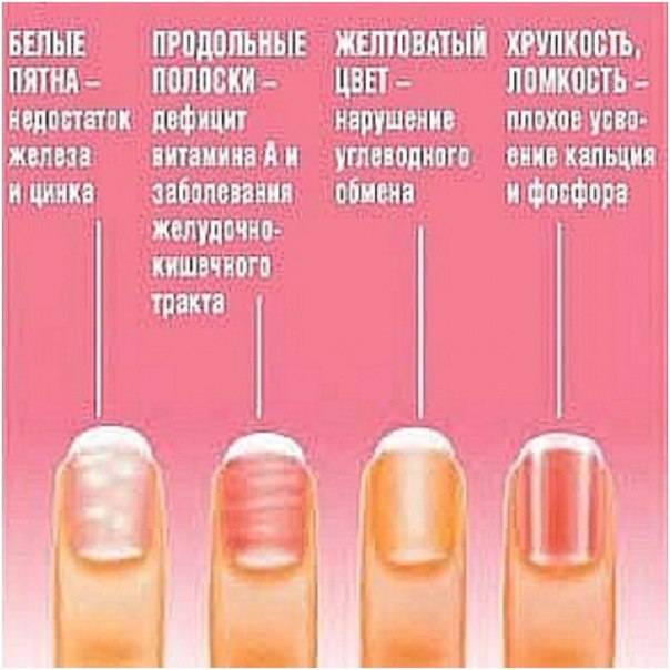 Почему цветут ногти и что при этом делать?
