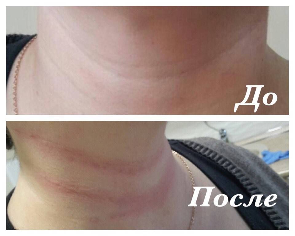 Кольца венеры на шее – мощные методы борьбы