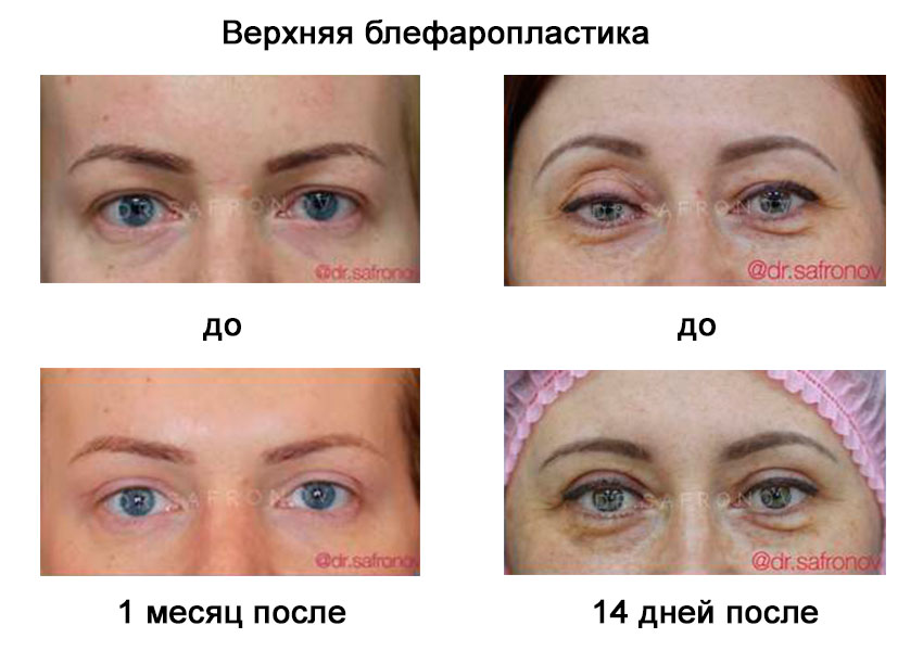 Лазерная блефаропластика - описание процедуры, показания, восстановление