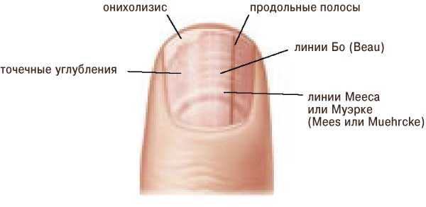 Почему появляются белые пятна на ногтях