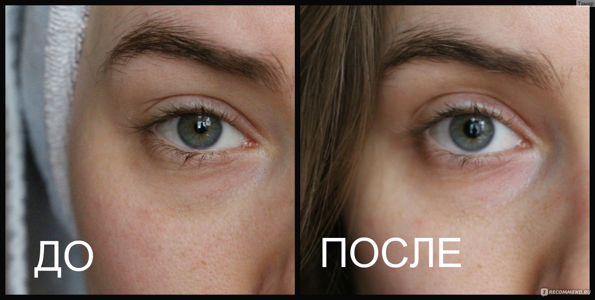 Как убрать темные круги под глазами в домашних условиях