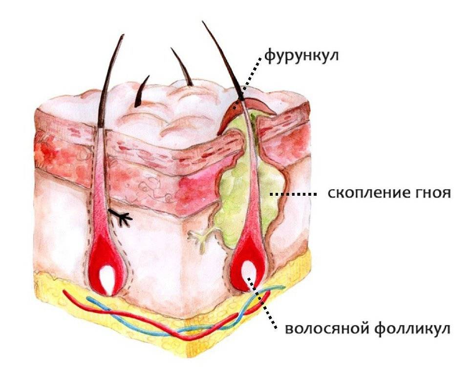 Лечение фурункула в домашних условиях