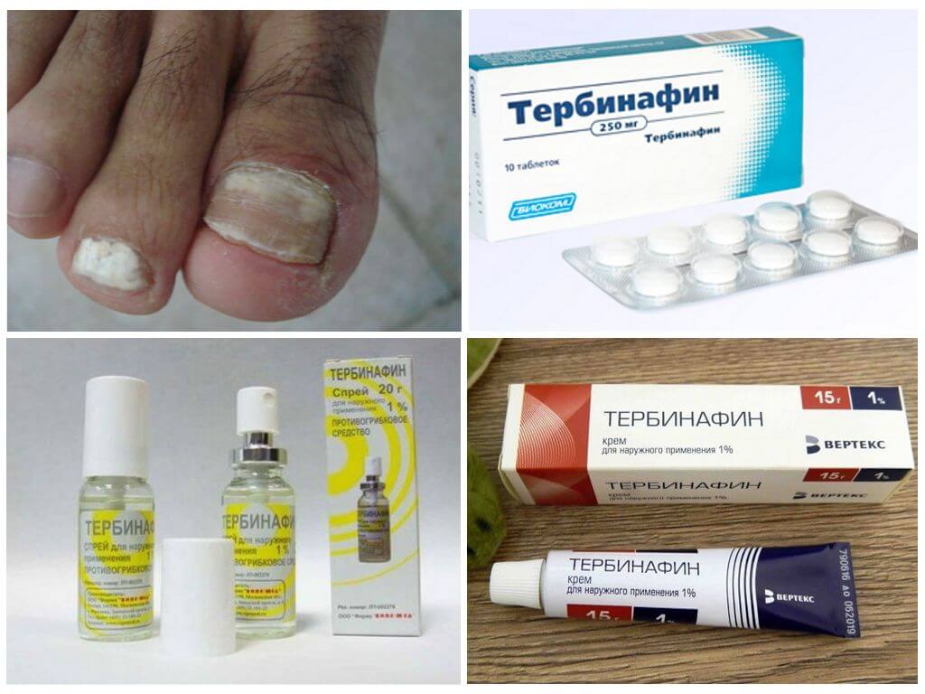 Средство от грибка ногтей: лечение недорогими, эффективными препаратами