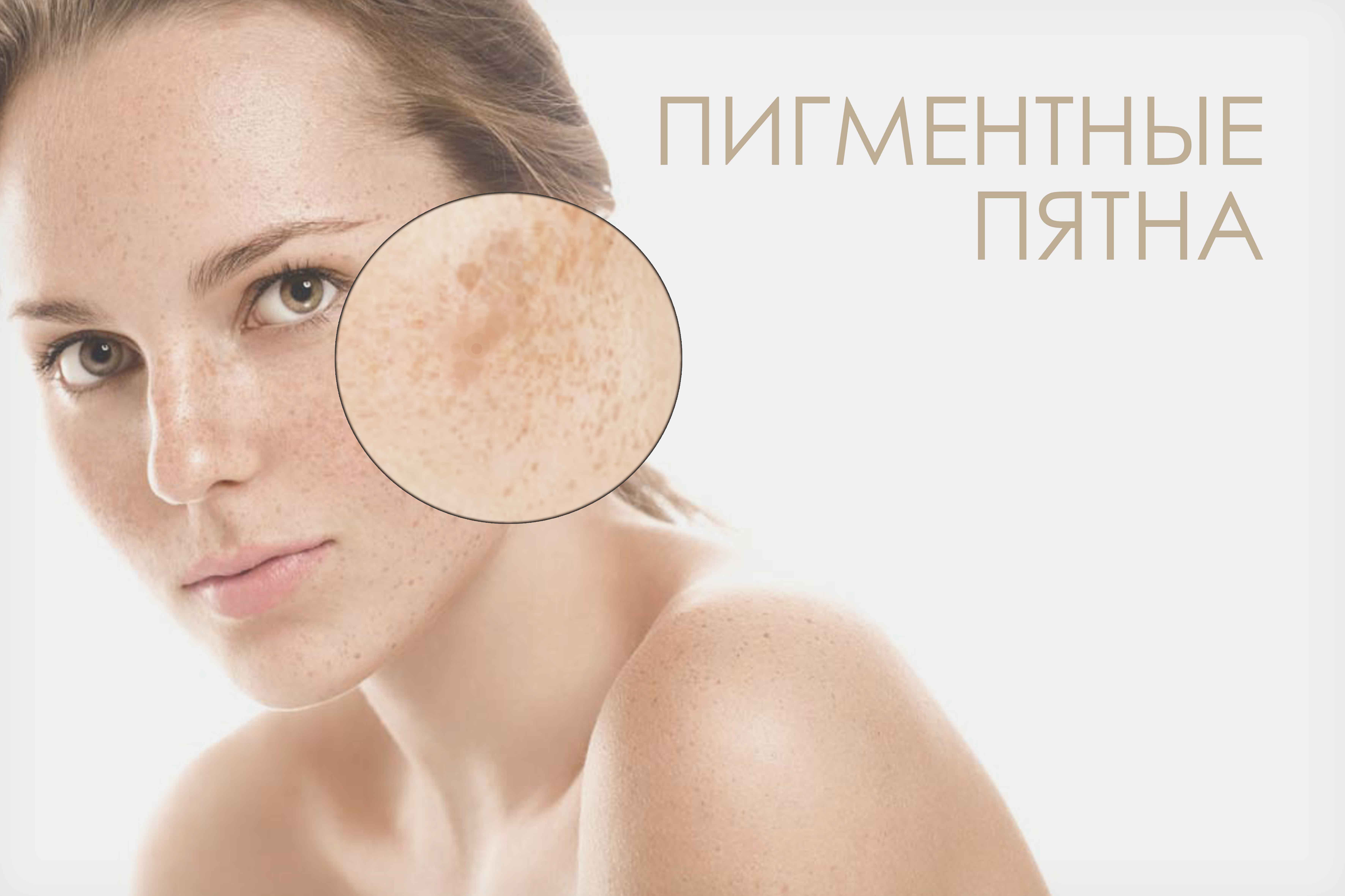Гиперпигментация кожи: причины появления и методы избавления - врач-косметолог наталия игоревна г. рошаль, шатура
