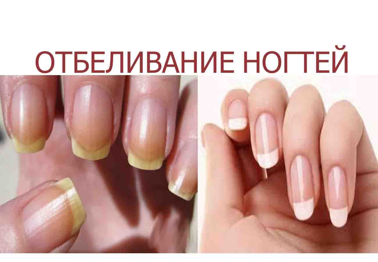 Специальные отбеливающие средства для ногтей
