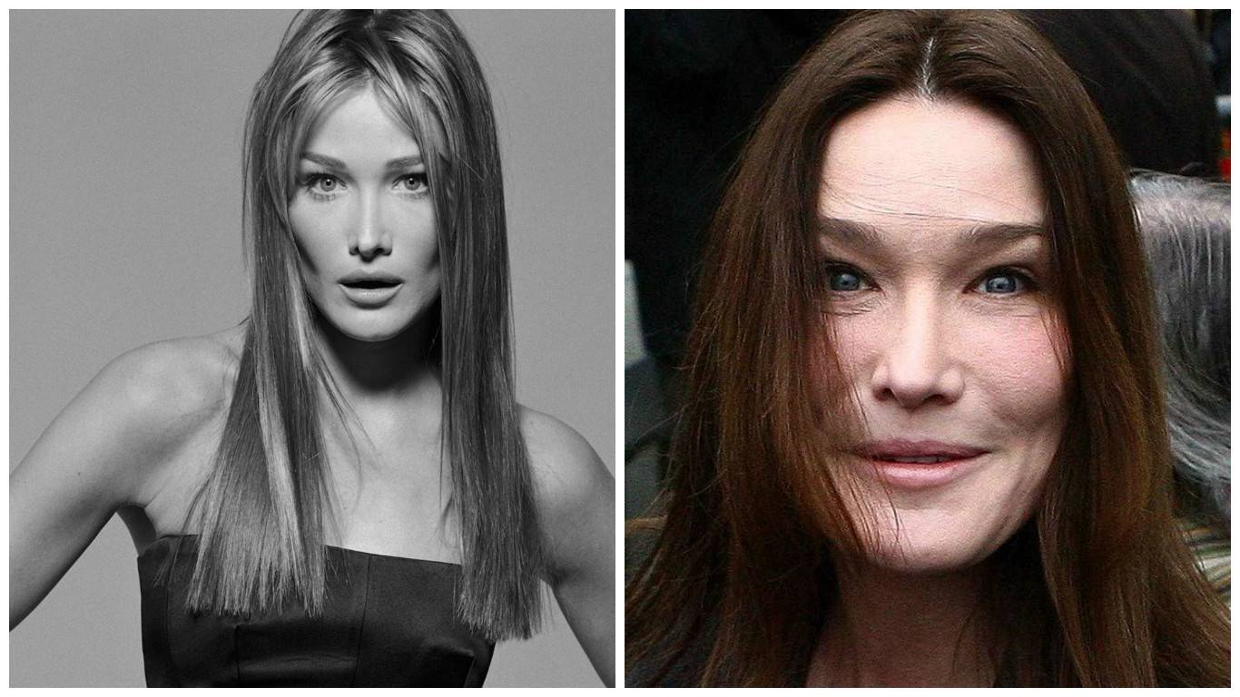 Carla bruni plastic surgery before and after pictures 2024