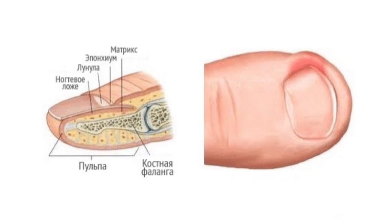 Мазь от вросшего ногтя