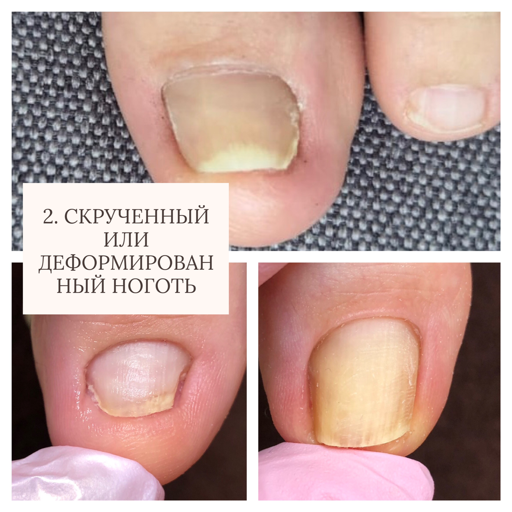 Онихолизис: лечение мазями, лаком и другими средствами