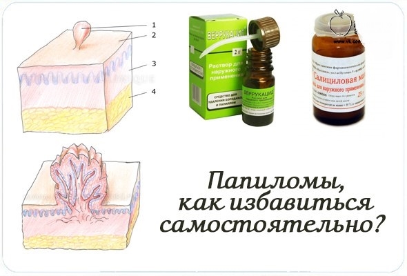 Папилломы на лице и теле: причины, виды, удаление и лечение