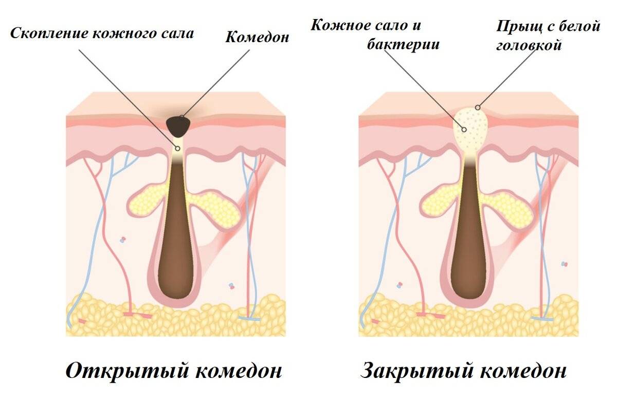 Как почистить забитые поры на лице в домашних условиях