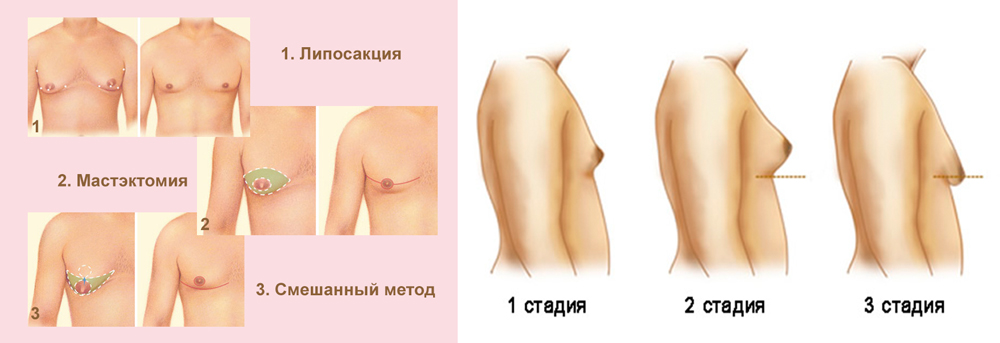 Втянутые соски: стадии, причины, осложнения, методы коррекции