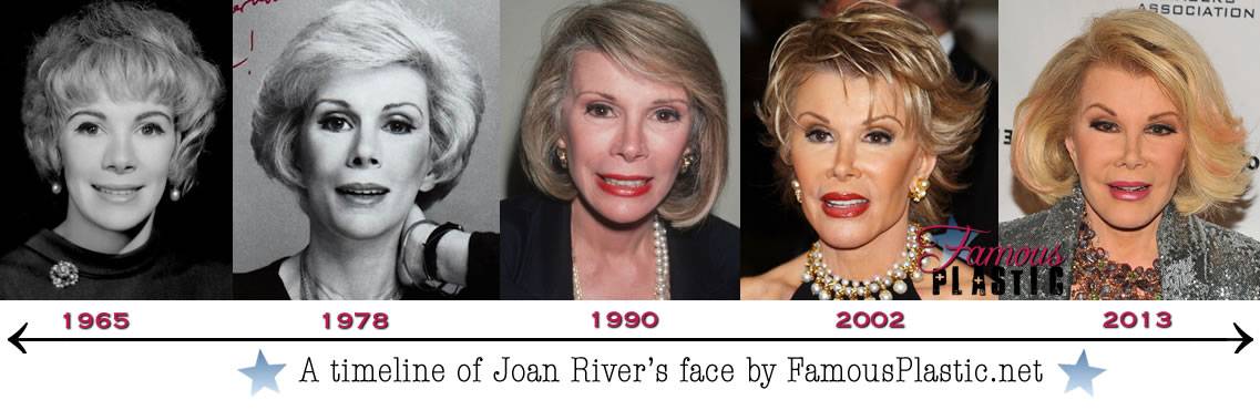 Joan rivers plastic surgery before and after photos - latest plastic surgery gossip and news. plastic surgery tips and advice