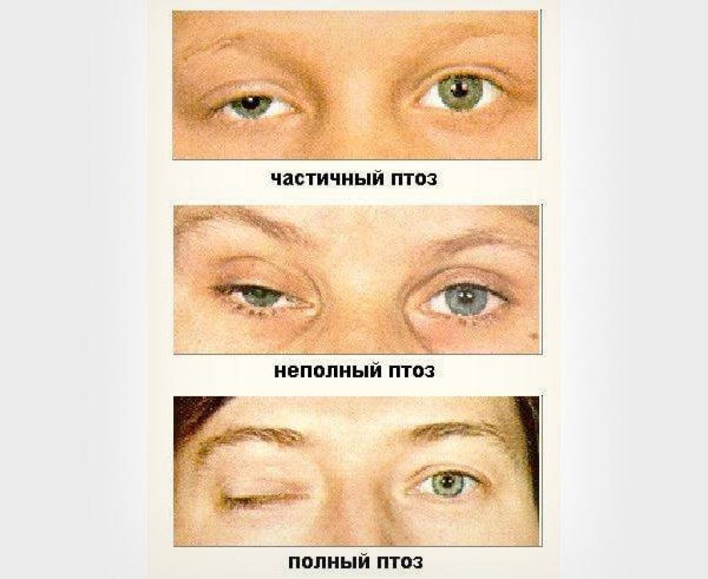 Птоз верхнего века: причины и симптомы, способы лечения, операция