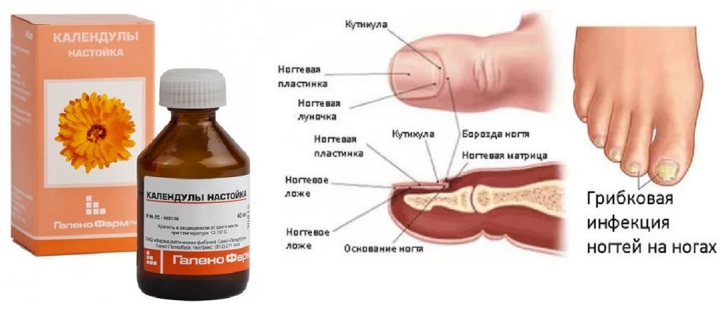 Лечение грибка ногтей на ногах в домашних условиях