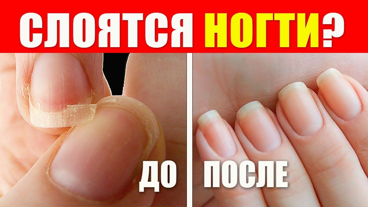 Что делать, если слоятся ногти: причины, лечение