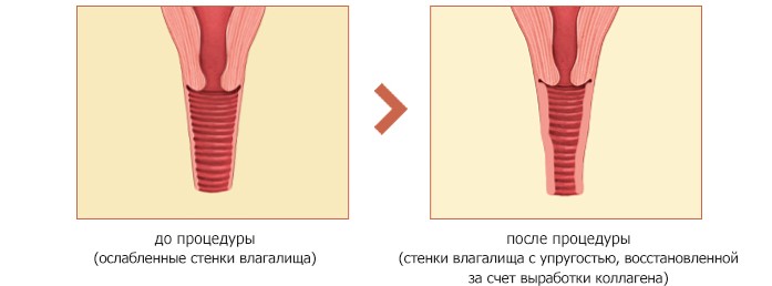 Перинеопластика – пластика влагалища после родов