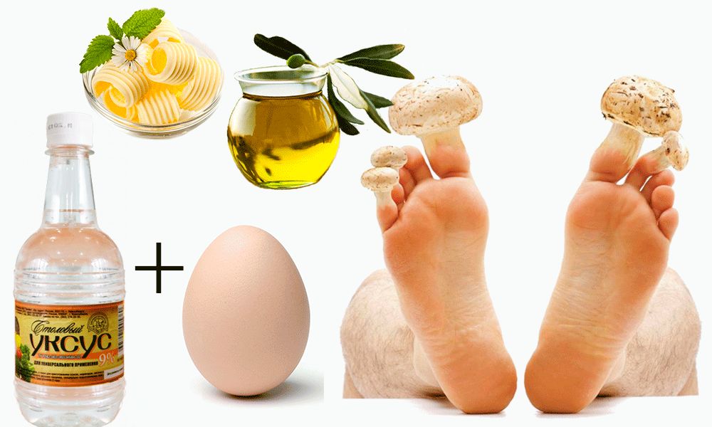 Лечение грибка ногтей народными средствами: самые эффективные